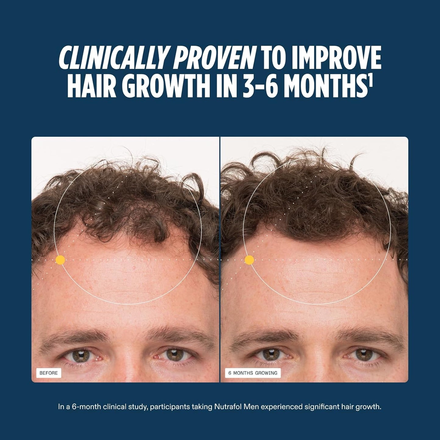 Before and after comparison of hair growth with text claiming clinical improvement in 3-6 months.