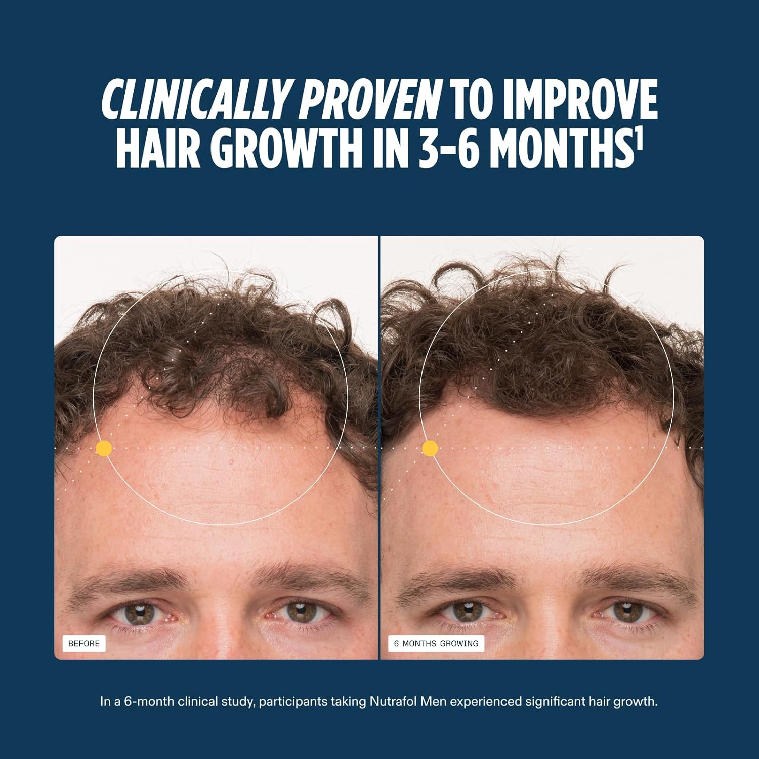 Before and after comparison of hair growth with text claiming clinical improvement in 3-6 months.